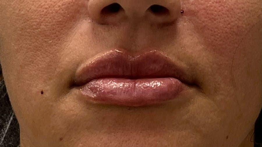 Preenchimento labial e bigode chinês — depois