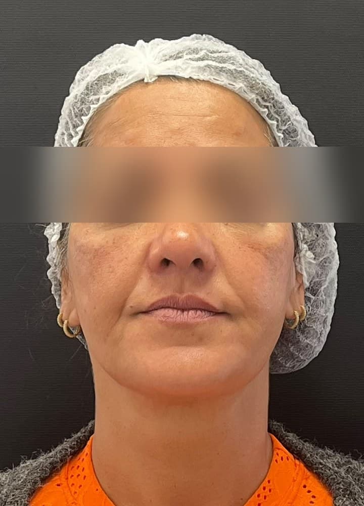 Preenchimento malar com efeito lifting — depois